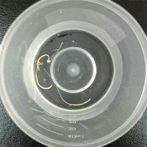 红河一妇女肚子疼  不是阑尾炎而是鞭虫作怪