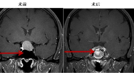 红河州第三人民医院经单鼻孔 内镜下垂体瘤切除术： 患者小尴尬消了