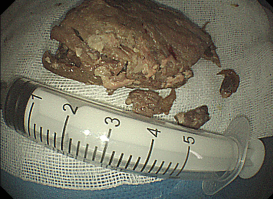 假牙嚼不碎肉块堵住一位妇女食管 红河州三医院巧取异物化险为夷