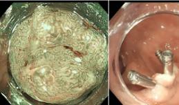 便血7个月到厦门就诊又返回   18岁的他在红河州肿瘤医院根治直肠癌
