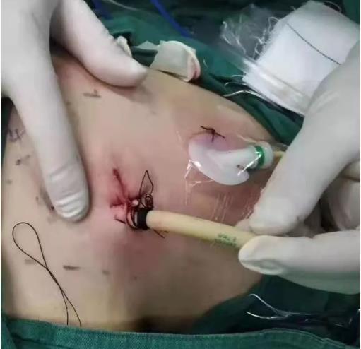 别怕：红河州肿瘤医院胸外科手术微创化 且单孔胸腔镜占95%以上