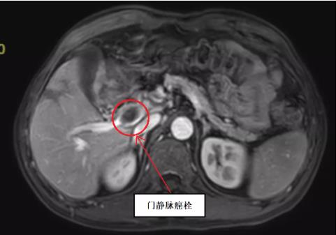 【医疗传真】石屏一位肝癌患者几经辗转 在红河州第三人民医院顺利手术出院