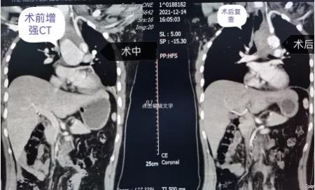 【医疗传真】化险为夷：矿工兄弟胸主动脉破裂伴巨大假性动脉瘤介入手术成功啦