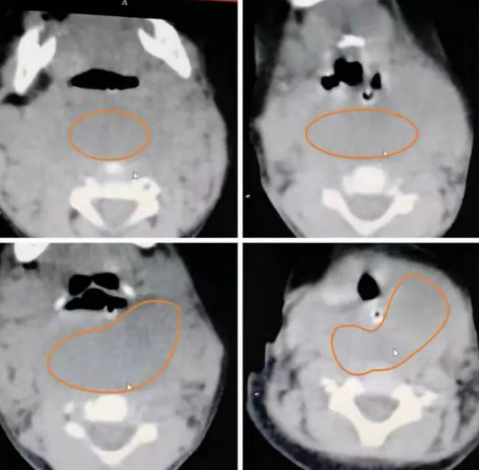 【医疗传真】红河州第三人民医院多学科合作 成功救治金平一个五龄危重患儿