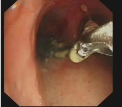 男子误吞刀片咳嗽疑患肿瘤 红河州第三人民医院支气管镜巧取异物