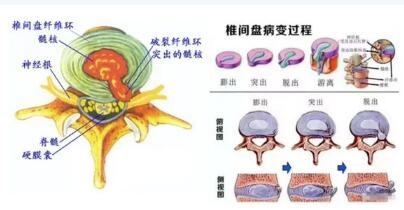 微创椎间孔镜下椎间盘摘除术：腰椎间盘突出症治疗的另一种选择
