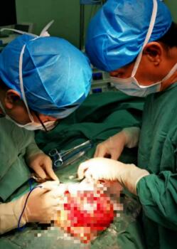 红河州第三人民医院为一患者进行肿瘤关节置换 实现重新站立行走