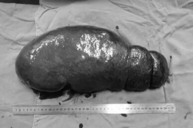 巨大脾脏肿瘤形如怀孕 红河州第三人民医院成功手术让患者如释重负