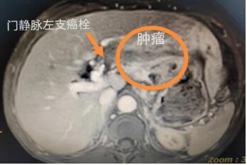 【医疗传真】红河州第三人民医院微创技术再提升 完成腹腔镜解剖性左半肝切除术