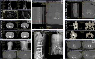 红河州第三人民医院开展脊柱转移瘤外科治疗， 提高患者生存质量