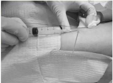 红河州第三医院首开全州“盐水隧道式PICC+心电导联尖端定位”先河