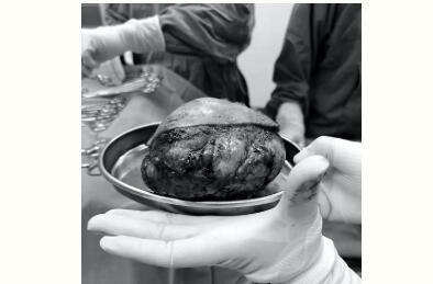 红河州第三人民医院为一名高中女生成功切除少见乳房巨大纤维瘤