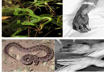 两男士遭遇两毒蛇咬伤 幸得红河州第三人民医院及时救治转危为安