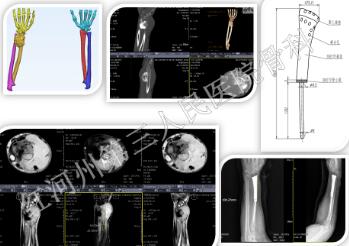 红河州第三人民医院率先在州内开展多项骨瘤保肢手术 切实造福患者
