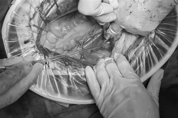 全州首例！当子宫肌瘤“遇上”神经鞘瘤 一个切口完成两个手术