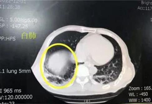 92岁新冠“阳”奶奶高热39.6度成功转阴 中医对症康复治疗很给力！
