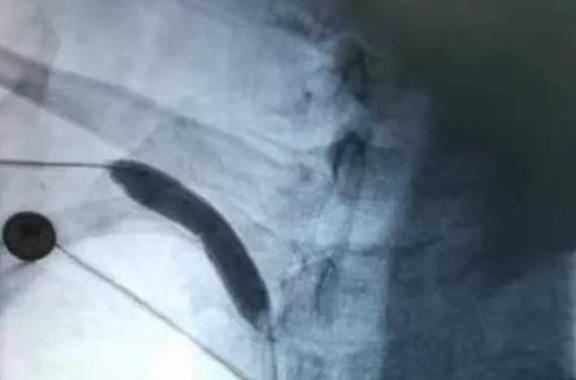 【担当卫健】红河州第三人民医院开展DSA下中心静脉球囊扩张术 造福“肿胀手”