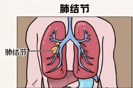 【健康宣教】“肺结节患者必看：别被肺结节吓到” 肺结节≠肺癌！揭秘真相，别被误导！