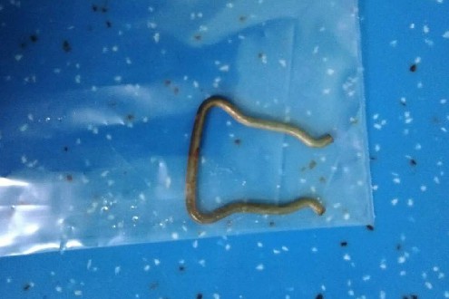 手术取出的钢丝卡 ~1.jpg