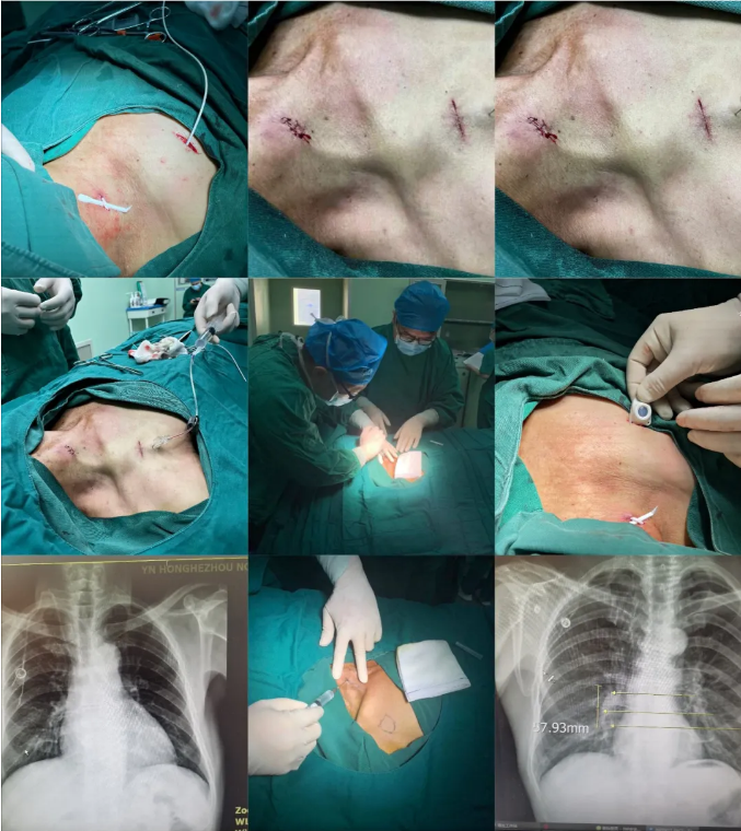 红河州第三人民医院开展静脉输液港植入术:"一针到位"可留终身